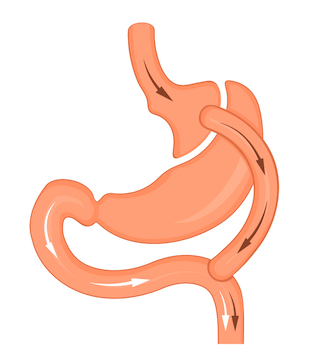 cirurgia_bariatrica_bypass